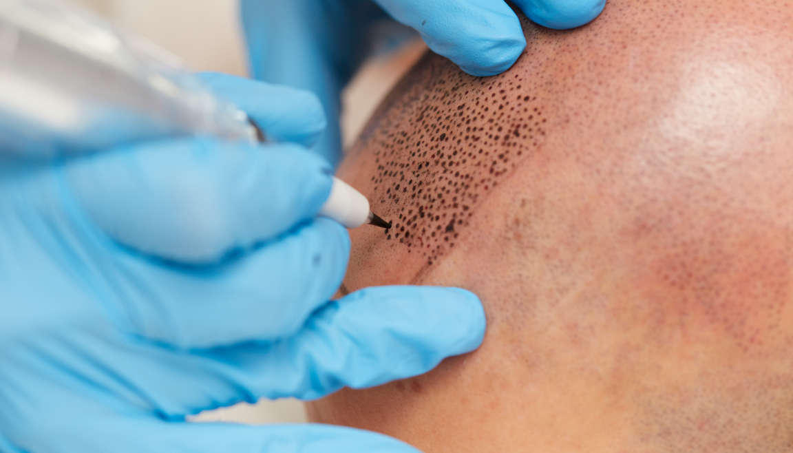 Follicraft scalp micropigmentation at wor with big follicles