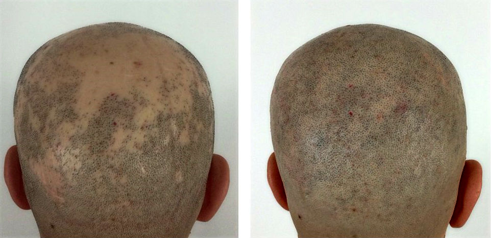 Alopecia_Areata