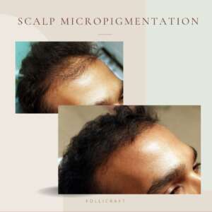 Scalp micropigmention density treatment dermakraft india