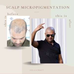 Scalp micropigmentation India Dermakraft