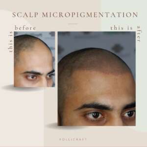 Scalp micropigmention for alopecia areata treatment dermakraft india