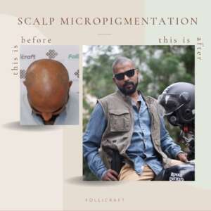 Scalp Micropigmentation Dermakraft India