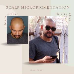 Scalp Micropigmentation Dermakraft India