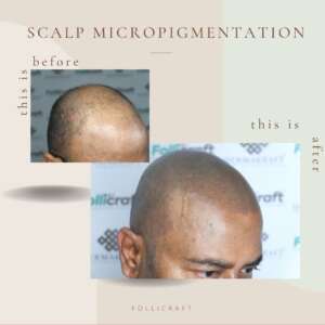 Scalp Micropigmentation Dermakraft India